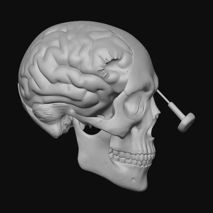 3D model for Trepanation Insight
