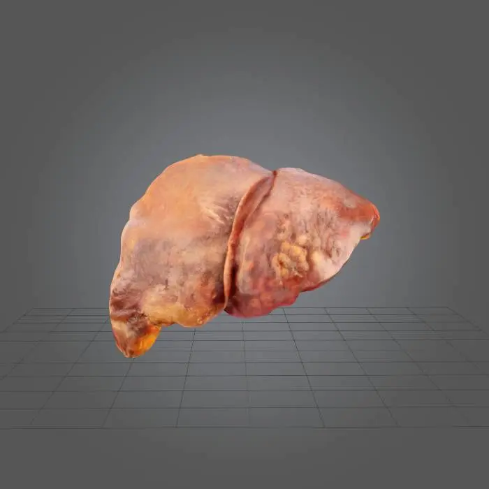 3D model for Diseased Liver Representation