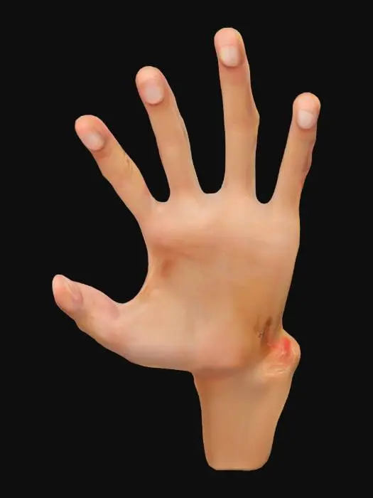 3D model for 손가락 다섯 마디와 손목이 포함된 손의 골절 된 엄지 손가락