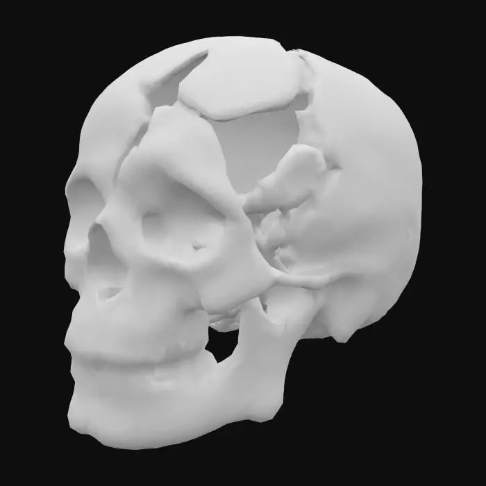 3D model for Fractured Skull