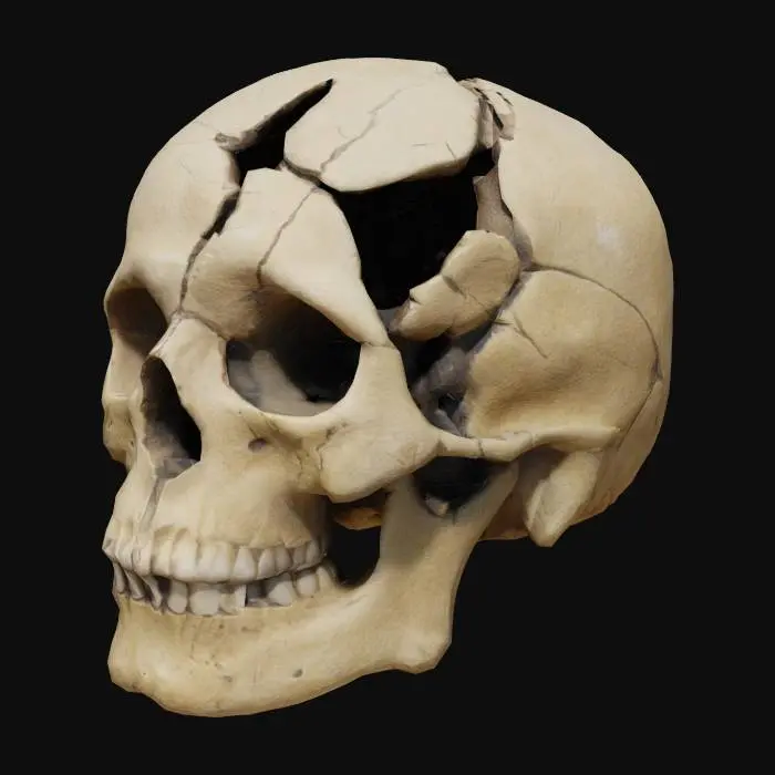3D model for Fractured Skull