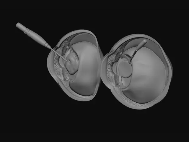 3D model for Phacoemulsification: Lens Removal Stages